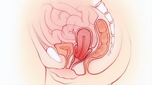 什么是子宫脱垂？该如何预防？