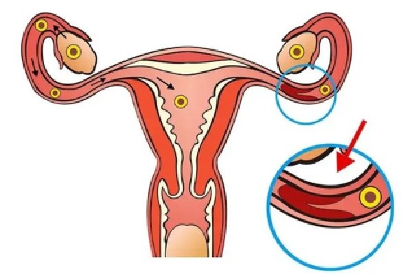 卵巢功能障碍是什么