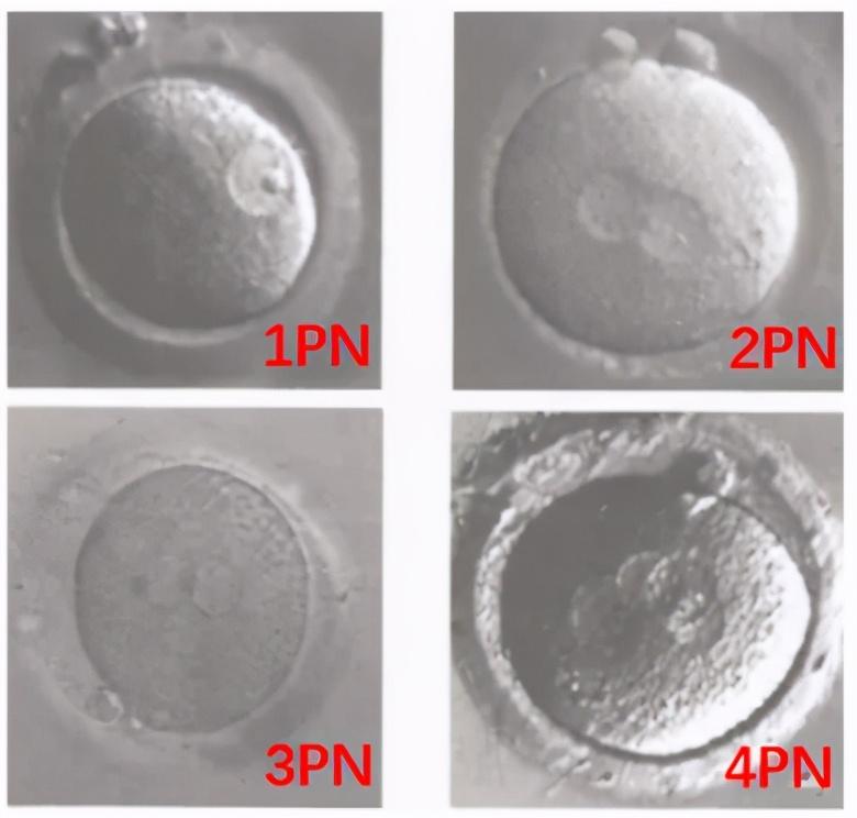 胚胎受精解读：2PN、0PN、1PN有什区别？