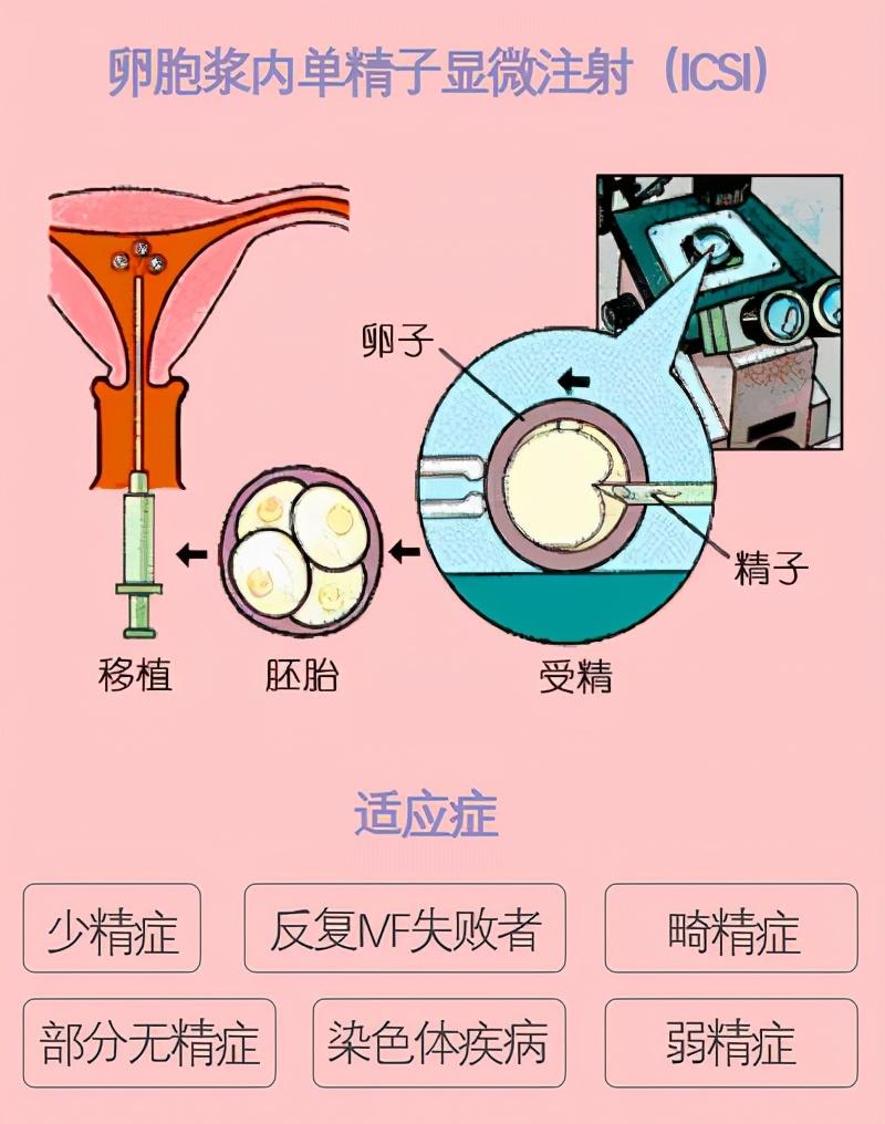 胚胎受精解读：2PN、0PN、1PN有什区别？