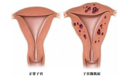 子宫后壁增厚一定是腺肌症吗