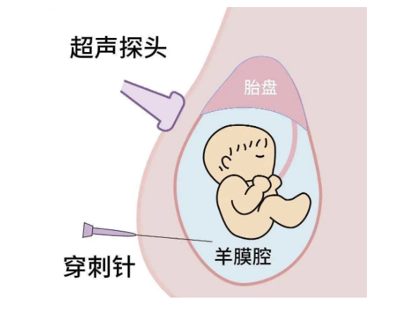 孕妇在孕期做了羊水穿刺仍有生下畸形儿的风险