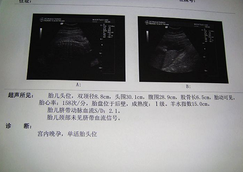 泰国试管婴儿成功好孕啦，和大家说说你们最关心的一些问题