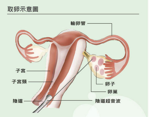 终于等到了泰国试管婴儿移植的这一天，希望一切顺利